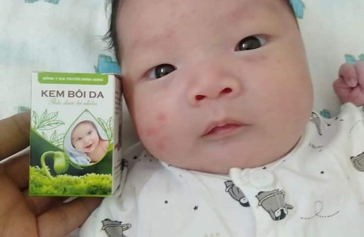 Kem bôi da Minh Hùng bôi chàm sữa được không?