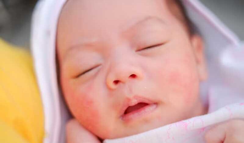 Cách trị dứt điểm chàm sữa và chăm sóc da cho bé