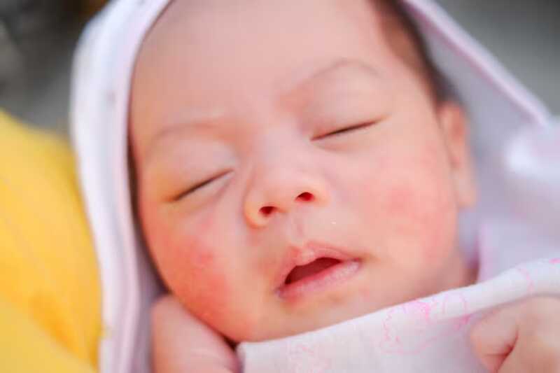 Cách trị dứt điểm chàm sữa và chăm sóc da cho bé