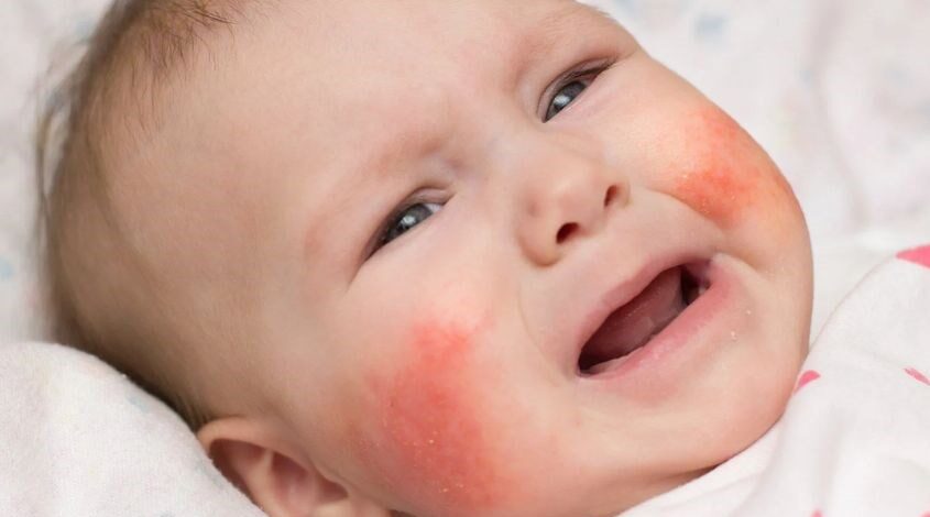 Chàm sữa ở trẻ sơ sinh có tự hết không? Giải đáp
