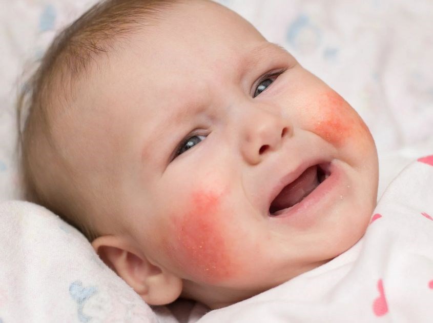 Chàm sữa ở trẻ sơ sinh có tự hết không? Giải đáp